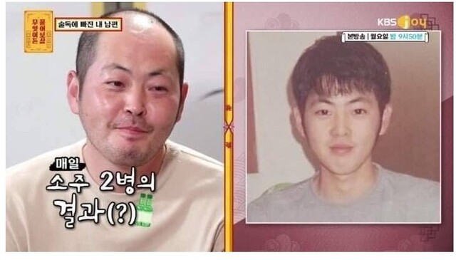 대머리 탈모 역변 매일 소주 2병의 결과 술 음주