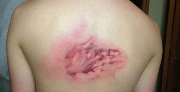 등짝 스매싱 아내 와이프 남편 등 손자국 선명 스메싱