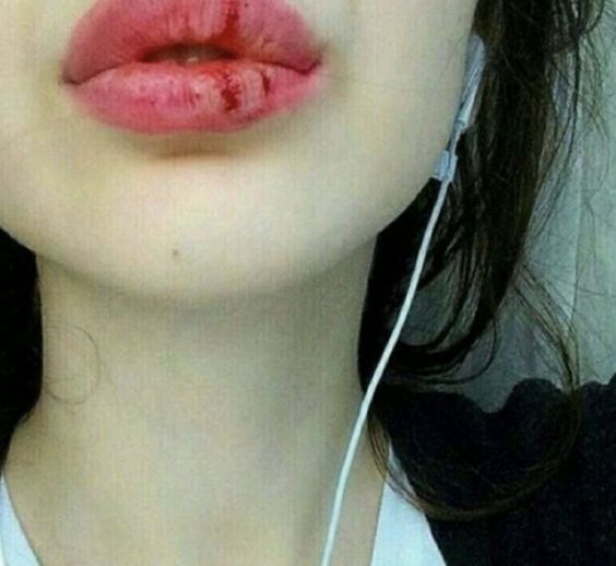 입술 여자 터진 상처
