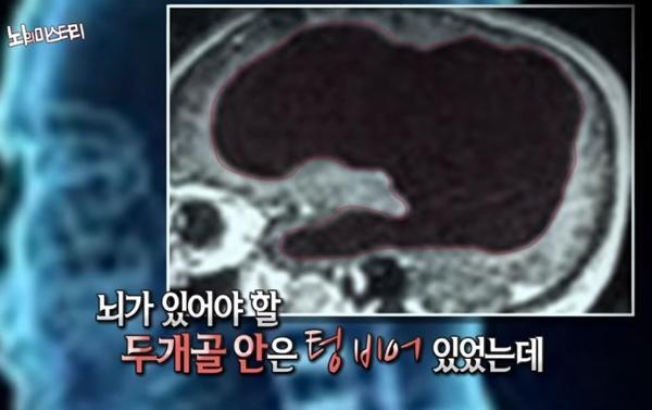 두개골 안은 텅비어 있었는데 뇌가 있어야할 자리에 뇌가 없어 무뇌 생각이 없다