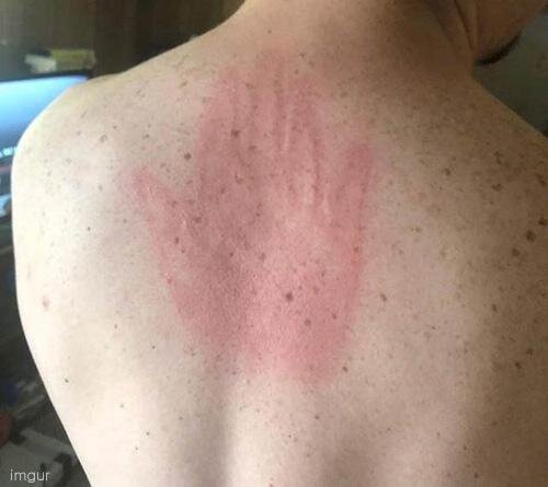 등짝 스메싱 손바닥 자국