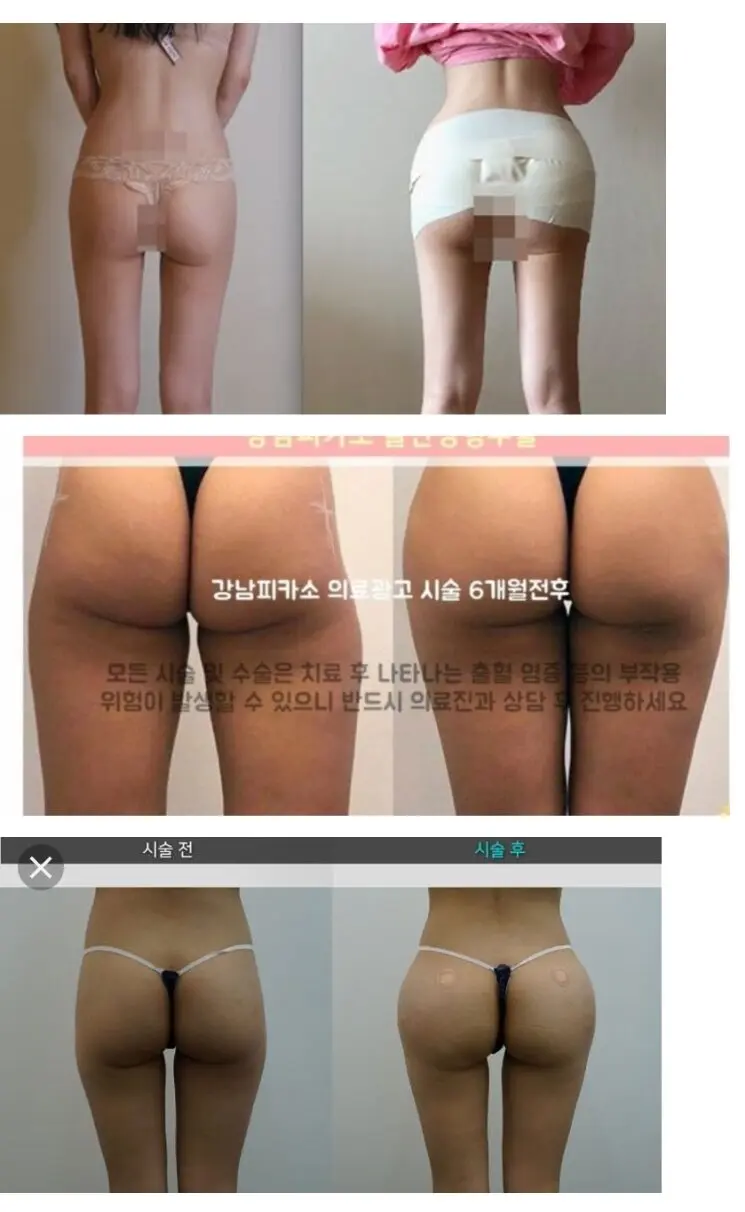 성형수술 근황
